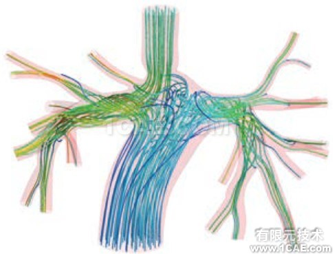 CFD模拟拯救患有致命心脏缺陷的婴儿 CFD模拟拯救患有致命心脏缺陷的婴儿